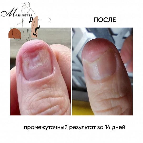 Масло для ногтей Nails Of The Day ONISTOP против онихолизиса 15 мл NOTD_82 фото